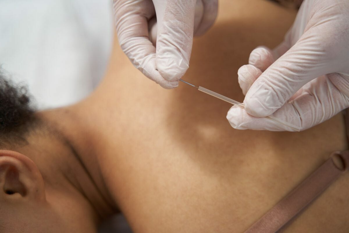 acupuncture seo services