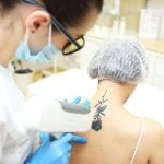 cosmetologist removes the tattoo to the patient